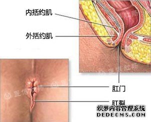 痔疮破裂出血几天能好